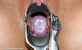 Exclusive Club Sara 421171 Sara Extreme Pussy Speculum Gaping At Gynecology Room By Skilled Practitioner
